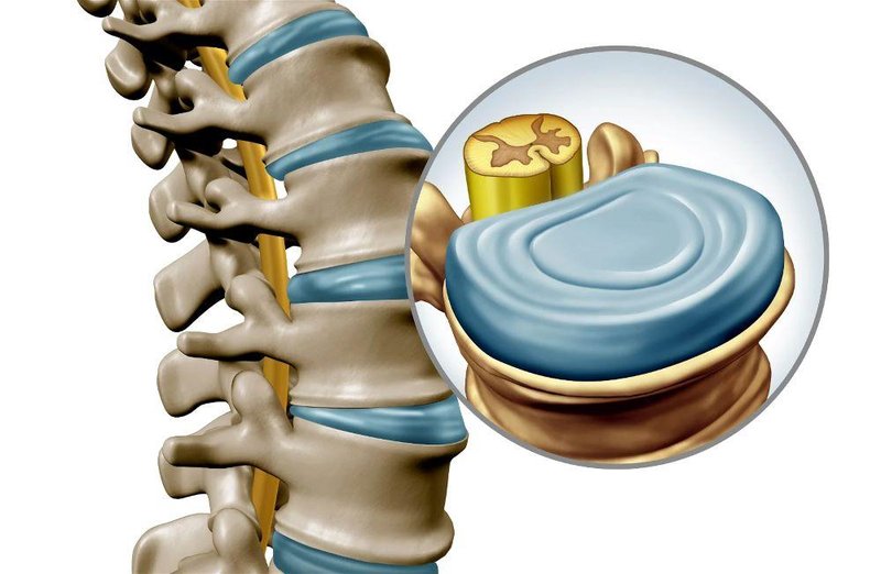 Hernija diska: Rehabilitacija ali operacija?