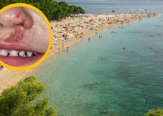 Pozor, če odhajate na Hrvaško: na plažah opažajo večje število primerov zelo nalezljive okužbe