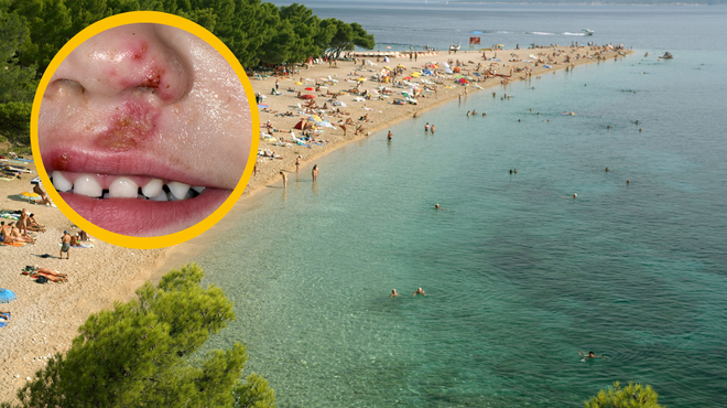 Pozor, če odhajate na Hrvaško: na plažah opažajo večje število primerov zelo nalezljive okužbe (foto: Profimedia/fotomontaža)