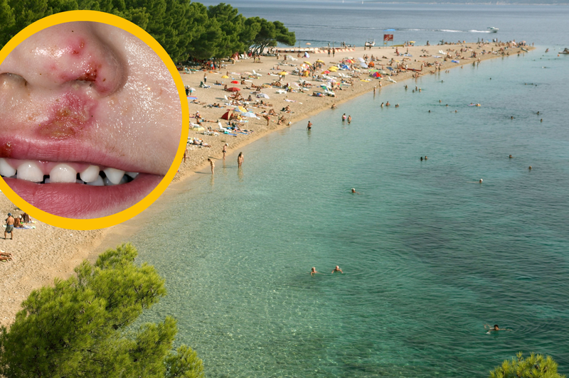 Pozor, če odhajate na Hrvaško: na plažah opažajo večje število primerov zelo nalezljive okužbe (foto: Profimedia/fotomontaža)